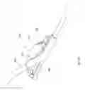 Fig. 07 - Method for using deformable medical implant