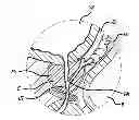 Fig. 01 - Median lobe destruction apparatus and method
