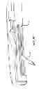 Fig. 07 - Median lobe destruction apparatus and method