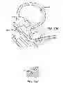 Fig. 09 - Median lobe destruction apparatus and method