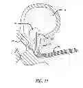 Fig. 10 - Median lobe destruction apparatus and method