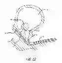 Fig. 11 - Median lobe destruction apparatus and method