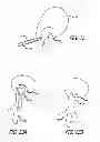 Fig. 16 - Median lobe destruction apparatus and method