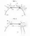 Fig. 02 - Method and device for approximating tissue