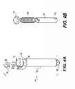 Fig. 04 - INTERNAL DYNAMIC SPLINT AND METHOD FOR USE THEREOF