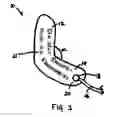 Fig. 02 - Automatic external defibrillator for implatable cardiac defibrillator patients undergoing procedures involving electromagnetic interference