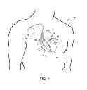 Fig. 02 - Reducing inappropriate delivery of therapy for suspected non-lethal arrhythmias