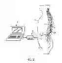Fig. 03 - Method for epidural stimulation of neural structures