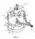 Fig. 06 - Method for epidural stimulation of neural structures