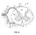 Fig. 10 - Method for epidural stimulation of neural structures