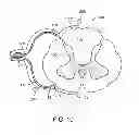 Fig. 11 - Method for epidural stimulation of neural structures