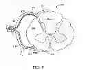 Fig. 12 - Method for epidural stimulation of neural structures