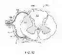 Fig. 13 - Method for epidural stimulation of neural structures