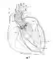 Fig. 02 - Methods for replacing a native heart valve and aorta with a prosthetic heart valve and conduit