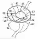 Fig. 01 - Two-part prosthetic valve system