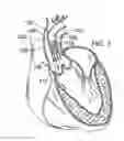 Fig. 04 - Two-part prosthetic valve system