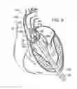 Fig. 06 - Two-part prosthetic valve system