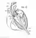Fig. 09 - Two-part prosthetic valve system