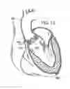 Fig. 10 - Two-part prosthetic valve system