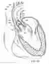 Fig. 12 - Two-part prosthetic valve system