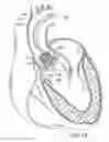 Fig. 13 - Two-part prosthetic valve system