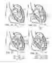 Fig. 14 - Two-part prosthetic valve system