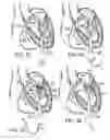 Fig. 15 - Two-part prosthetic valve system