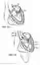Fig. 16 - Two-part prosthetic valve system