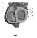 Fig. 02 - Patient-specific intraluminal implants