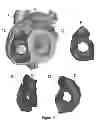 Fig. 07 - Patient-specific intraluminal implants