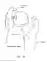 Fig. 09 - Method and apparatus for re-attaching the labrum of a hip joint
