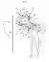 Fig. 02 - Artificial joint components including synovial fluid deflecting structures and particle retaining structures