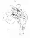 Fig. 02 - Artificial joint components including mechanized synovial fluid deflecting structures and particle retaining structures