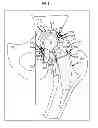Fig. 03 - Artificial joint components including mechanized synovial fluid deflecting structures and particle retaining structures