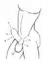 Fig. 01 - Condom device