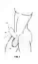 Fig. 08 - Condom device