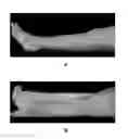 Fig. 01 - Method for treating and confirming diagnosis of exertional compartment syndrome