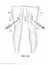 Fig. 02 - Method for treating and confirming diagnosis of exertional compartment syndrome