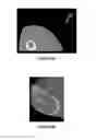 Fig. 06 - Method for treating and confirming diagnosis of exertional compartment syndrome