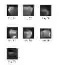 Fig. 07 - Compositions, methods and kits for remineralization and inhibition of dental caries in teeth