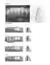 Fig. 02 - BUTTON FOR IMPLNAT HEALING ABUTMENT AND IMPLANT HEALING ABUTMENT HAVING PRESSING PART