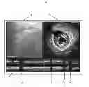 Fig. 08 - Accounting for non-uniform longitudinal motion during movement of an endoluminal imaging probe