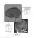 Fig. 06 - Computatonal tool for pre-surgical evaluation of patients with medically refractory epilepsy