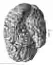 Fig. 09 - Computatonal tool for pre-surgical evaluation of patients with medically refractory epilepsy
