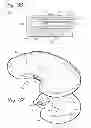 Fig. 22 - DISTRACTOR FOR MEASURING LOAD AND POSITION OF LOAD APPLIED BY THE MUSCULAR-SKELETAL SYSTEM AND METHOD THEREFOR