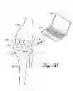 Fig. 33 - DISTRACTOR FOR MEASURING LOAD AND POSITION OF LOAD APPLIED BY THE MUSCULAR-SKELETAL SYSTEM AND METHOD THEREFOR