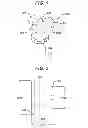Fig. 02 - Tympanic membrane pressure equalization tube