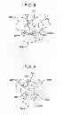 Fig. 05 - Tympanic membrane pressure equalization tube