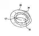 Fig. 01 - Guide Device for Intraocular Injection