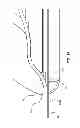 Fig. 25 - Guidewire extension system for a catheter placement device